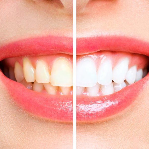 Tannbleking hjemme kontra tannlegen: Hvorfor eksperter advarer mot DIY-metoder
