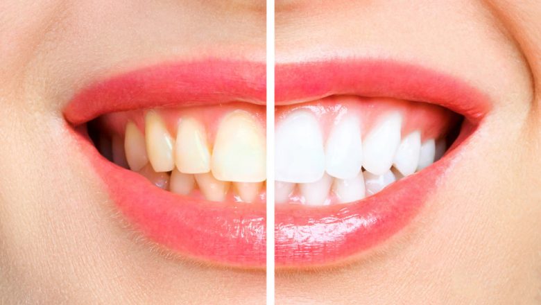 Tannbleking hjemme kontra tannlegen: Hvorfor eksperter advarer mot DIY-metoder